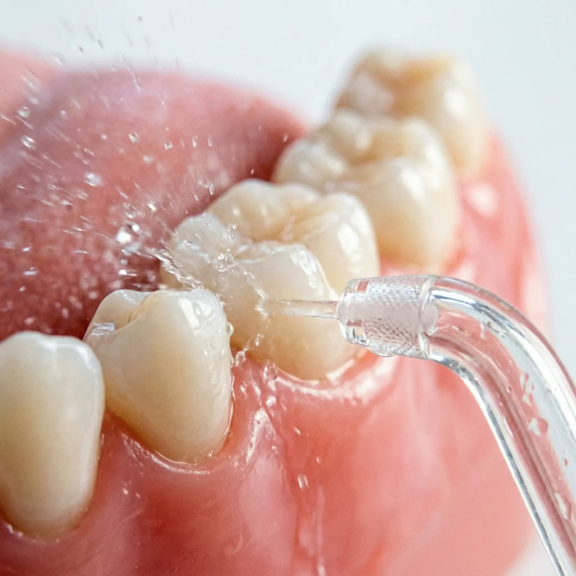 Water flosser tip spraying a fine stream for gum care