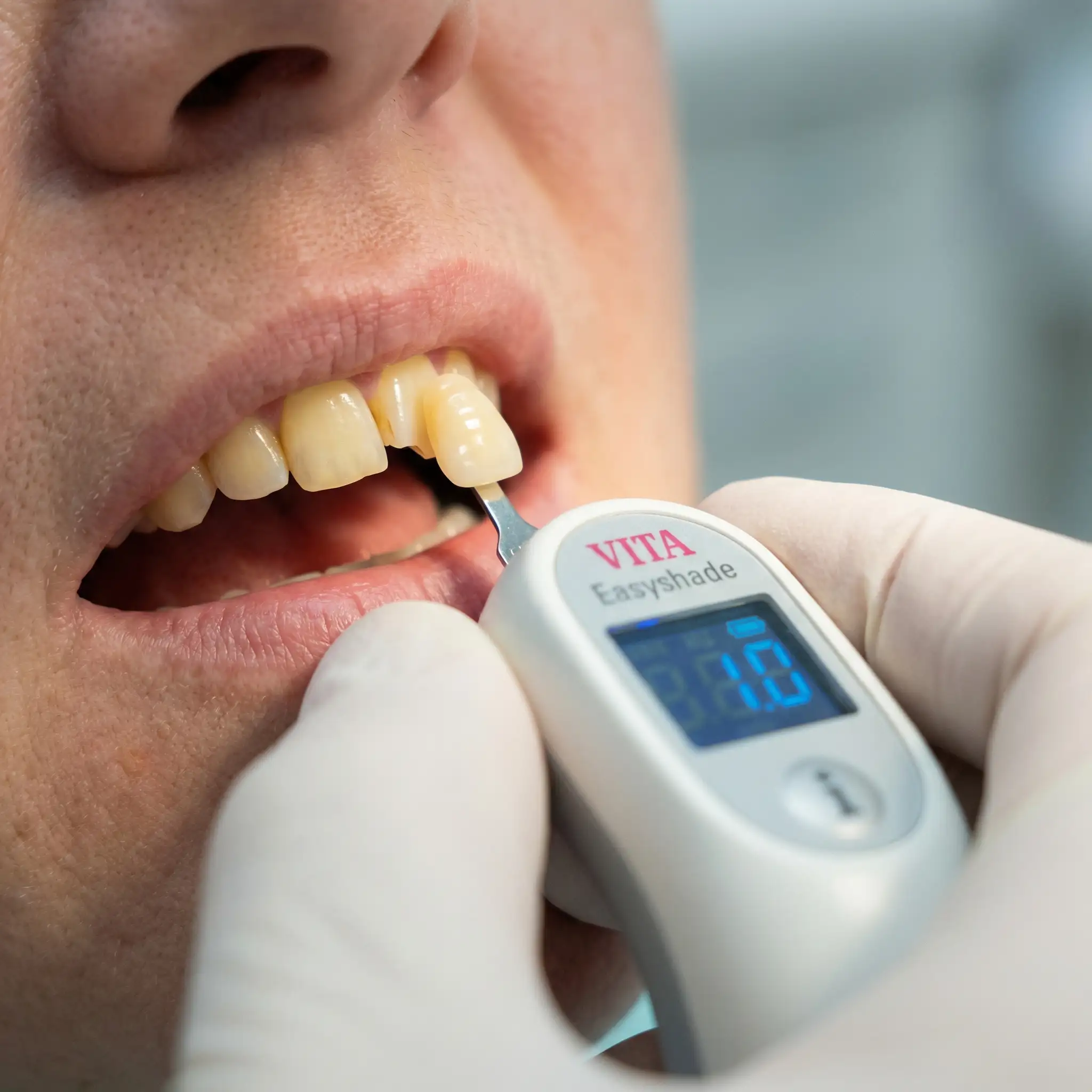 Digital shade matching